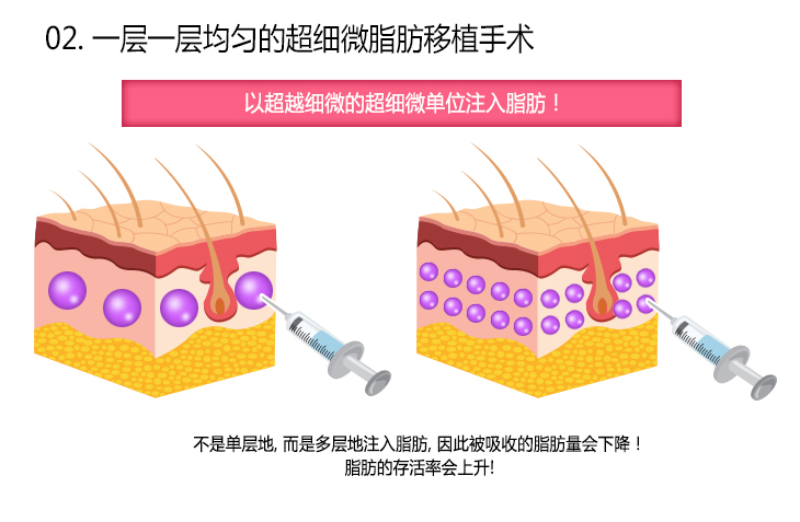 [02.一层一层均匀的超细微脂肪移植手术] 以超越细微的超细微单位注入脂肪！不是单层地，而是多层地注入脂肪，因此被吸收的脂肪量会下降！脂肪的存活率会上升！